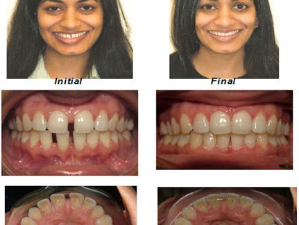 Orthodontics in Dentist in NYC dentist-brooklyn.com Advanced Dental Care Advanced Dental Care of NYC 718-624-1970